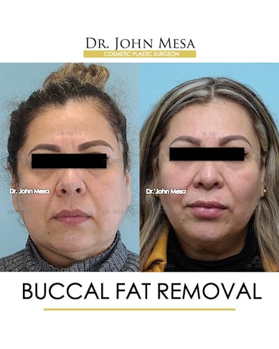 Buccal Fat Pad Removal Before & After Gallery - Patient 148733478 - Image 1