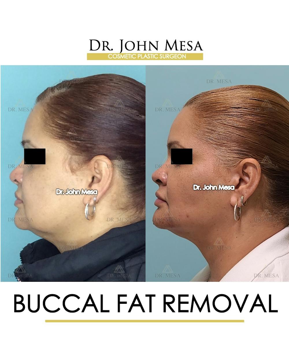 Buccal Fat Pad Removal Before & After Gallery - Patient 148733477 - Image 5