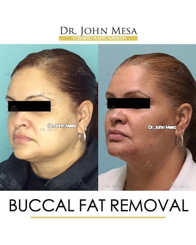 Buccal Fat Pad Removal Before & After Gallery - Patient 148733477 - Image 4
