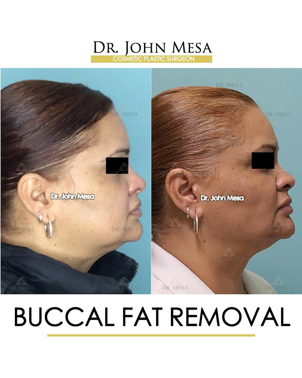 Buccal Fat Pad Removal Before & After Gallery - Patient 148733477 - Image 3