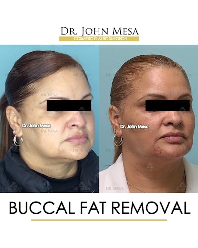 Buccal Fat Pad Removal Before & After Gallery - Patient 148733477 - Image 2