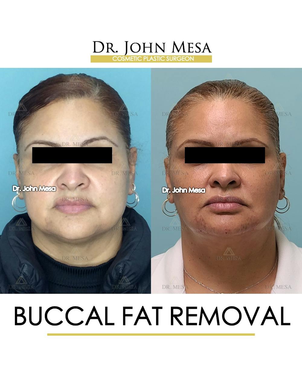 Buccal Fat Pad Removal Before & After Gallery - Patient 148733477 - Image 1