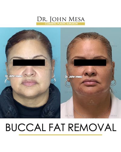 Buccal Fat Pad Removal Before & After Gallery - Patient 148733477 - Image 1