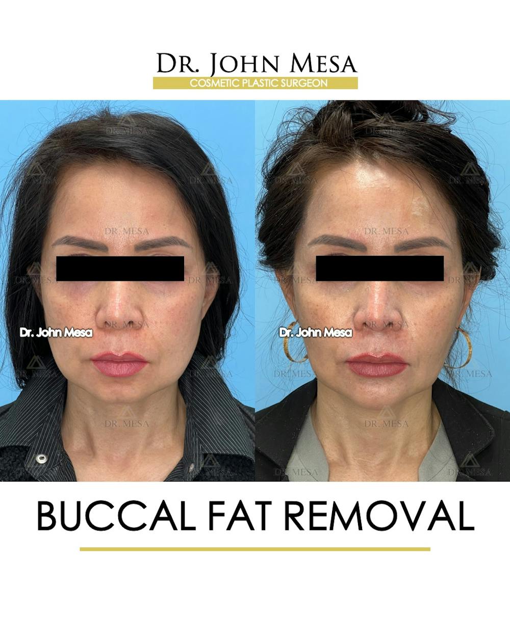 Buccal Fat Pad Removal Before & After Gallery - Patient 148733476 - Image 1
