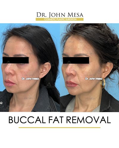 Buccal Fat Pad Removal Before & After Gallery - Patient 148733476 - Image 4