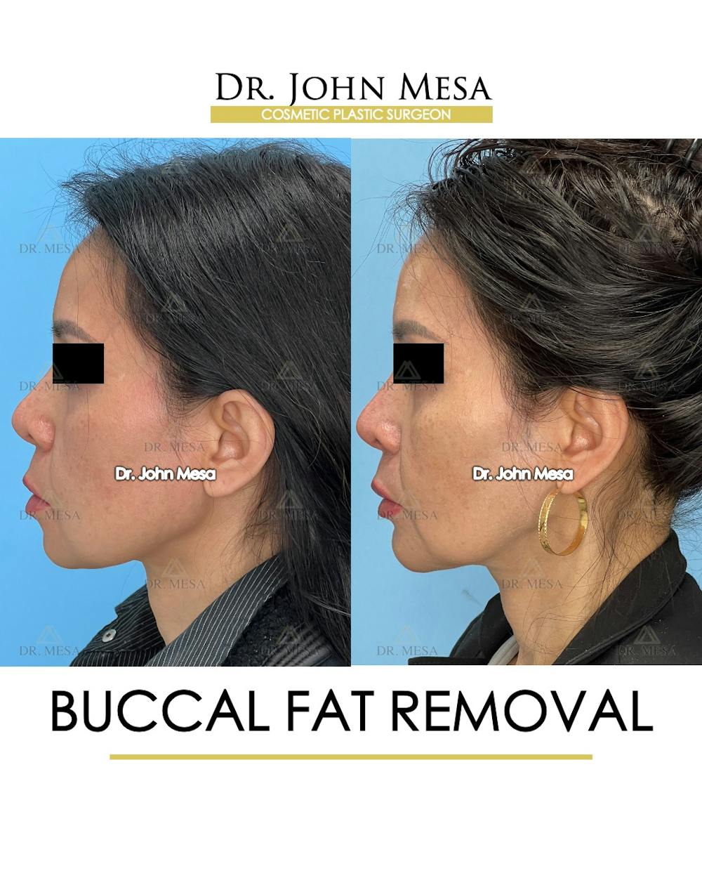 Buccal Fat Pad Removal Before & After Gallery - Patient 148733476 - Image 5