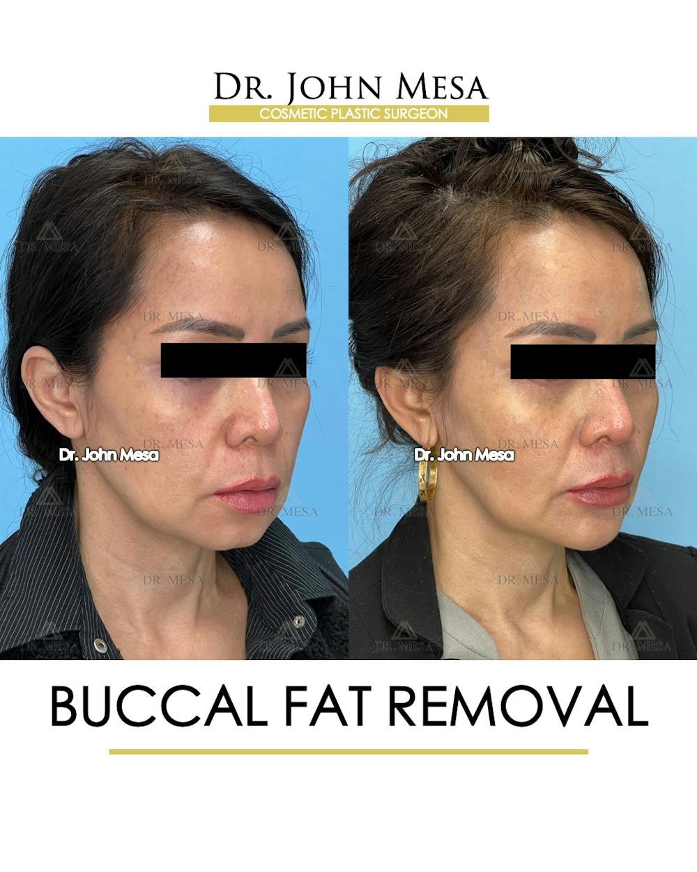 Buccal Fat Pad Removal Before & After Gallery - Patient 148733476 - Image 2