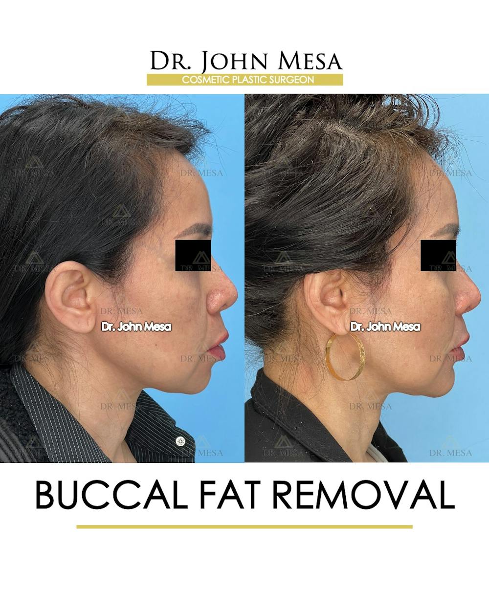 Buccal Fat Pad Removal Before & After Gallery - Patient 148733476 - Image 3