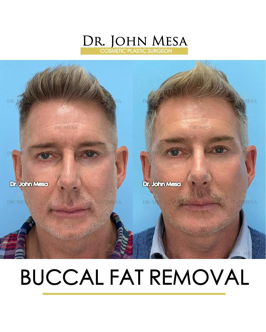 Buccal Fat Pad Removal for Men Before & After Gallery - Patient 148733549 - Image 1