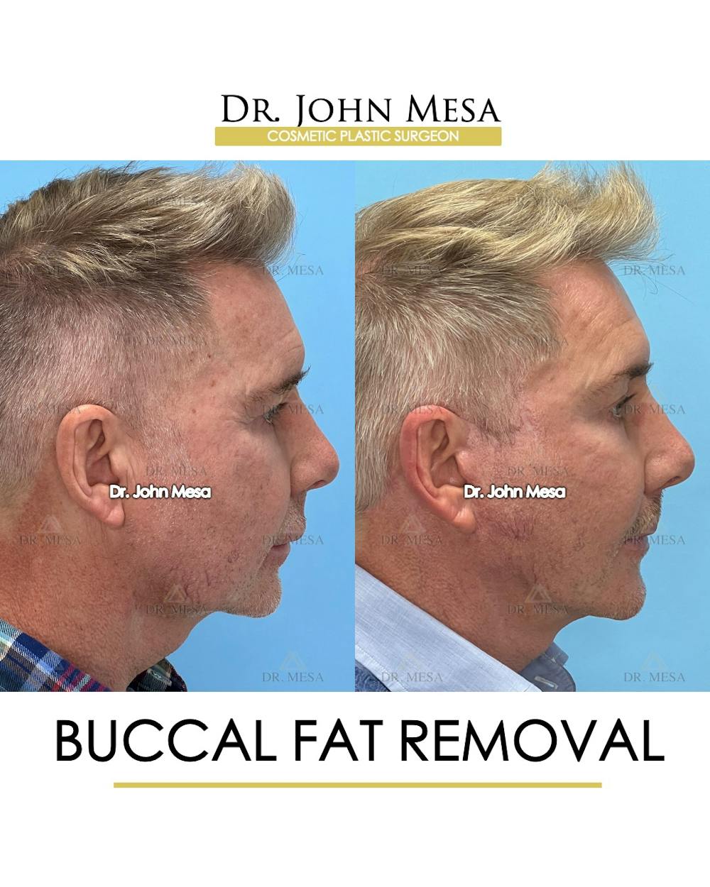 Buccal Fat Pad Removal for Men Before & After Gallery - Patient 148733549 - Image 3