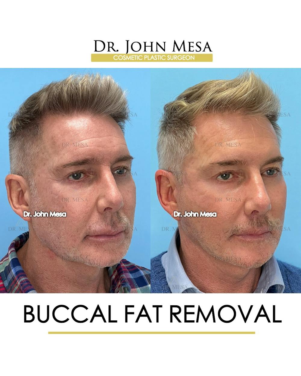 Buccal Fat Pad Removal for Men Before & After Gallery - Patient 148733549 - Image 2
