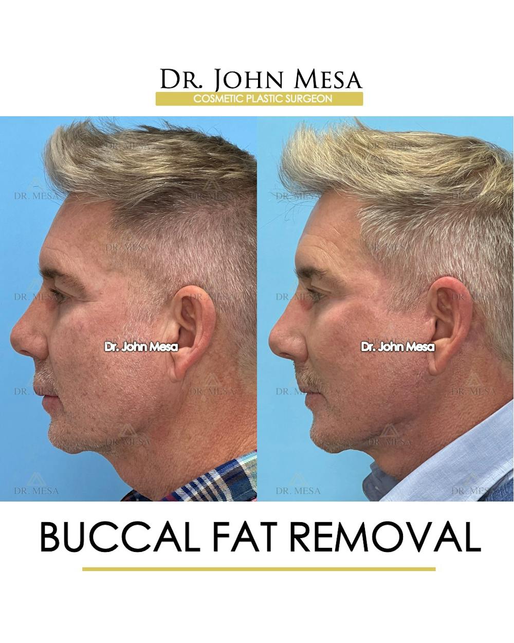 Buccal Fat Pad Removal for Men Before & After Gallery - Patient 148733549 - Image 5