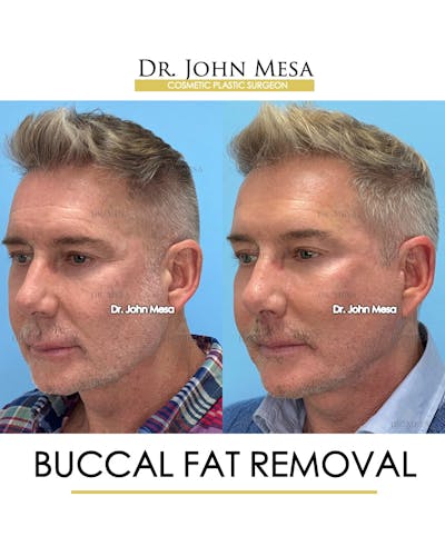 Buccal Fat Pad Removal for Men Before & After Gallery - Patient 148733549 - Image 4