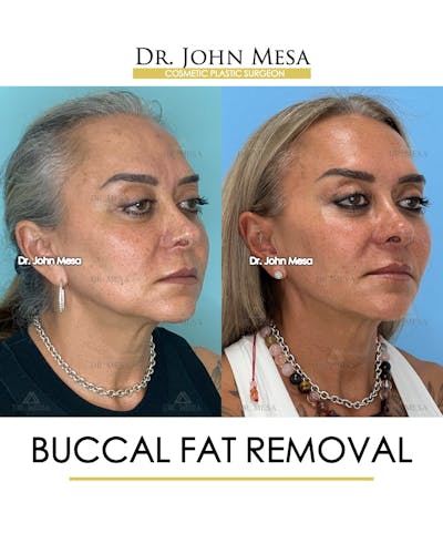 Buccal Fat Pad Removal Before & After Gallery - Patient 148733475 - Image 2
