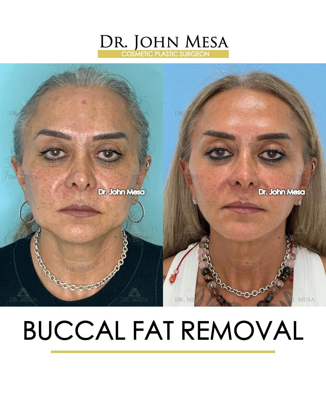 Buccal Fat Pad Removal Before & After Gallery - Patient 148733475 - Image 1