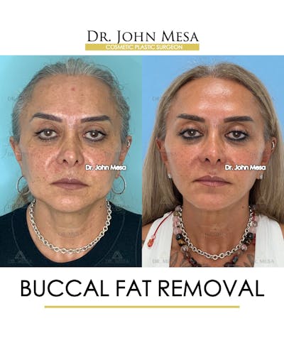Buccal Fat Pad Removal Before & After Gallery - Patient 148733475 - Image 1