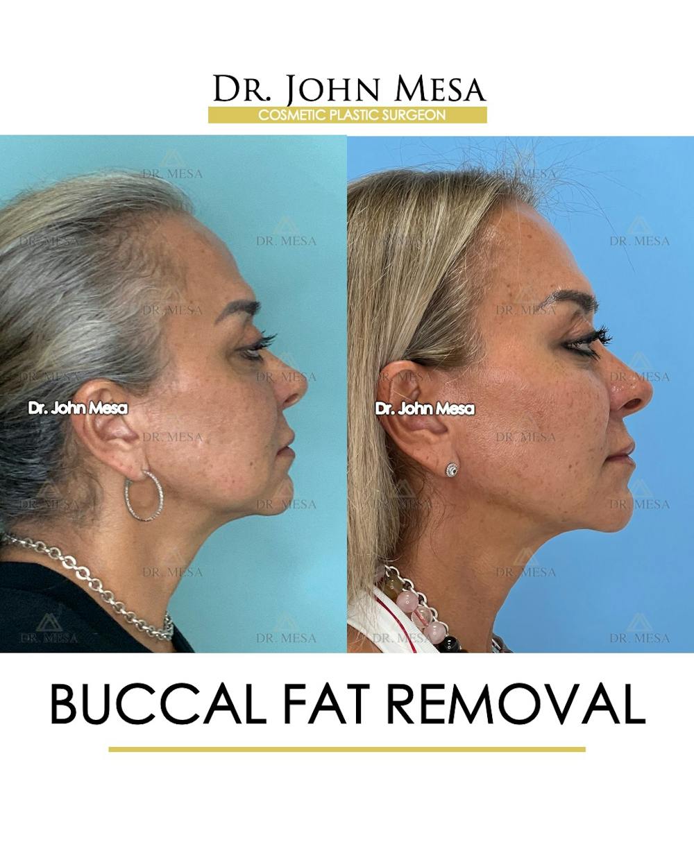 Buccal Fat Pad Removal Before & After Gallery - Patient 148733475 - Image 3