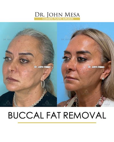 Buccal Fat Pad Removal Before & After Gallery - Patient 148733475 - Image 4