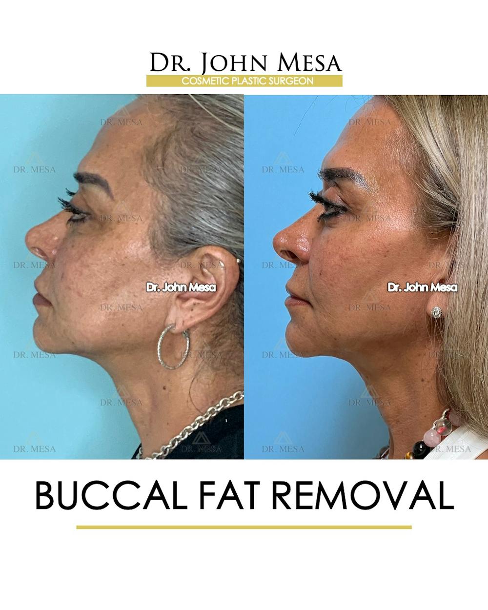Buccal Fat Pad Removal Before & After Gallery - Patient 148733475 - Image 5