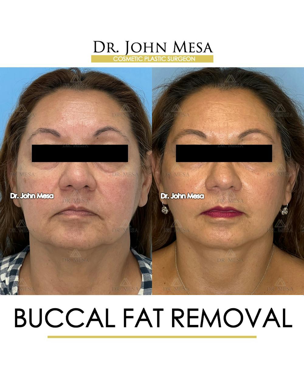 Buccal Fat Pad Removal Before & After Gallery - Patient 148733474 - Image 1