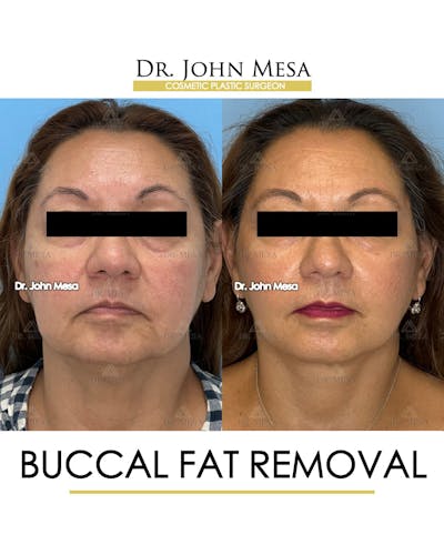 Buccal Fat Pad Removal Before & After Gallery - Patient 148733474 - Image 1