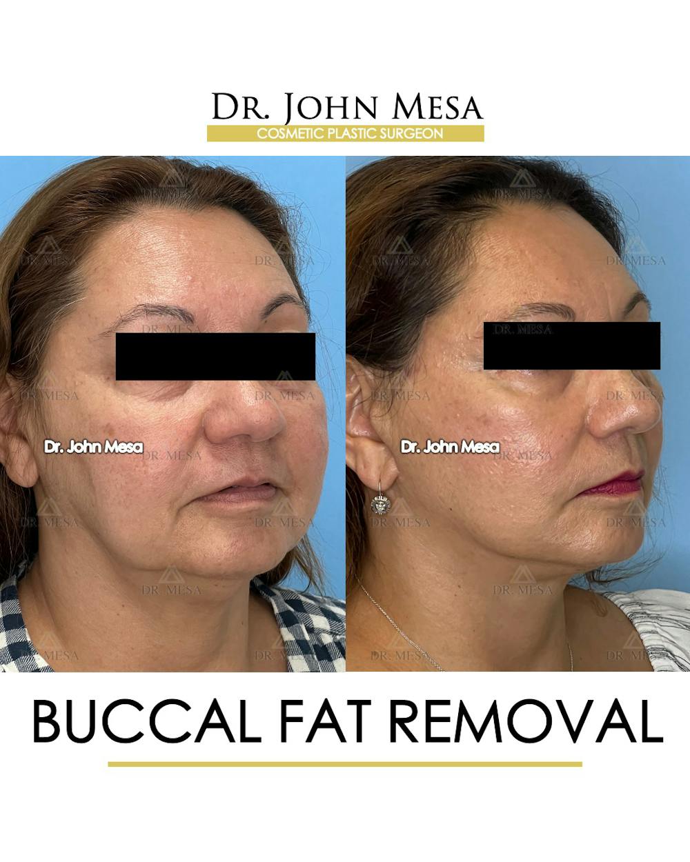 Buccal Fat Pad Removal Before & After Gallery - Patient 148733474 - Image 2