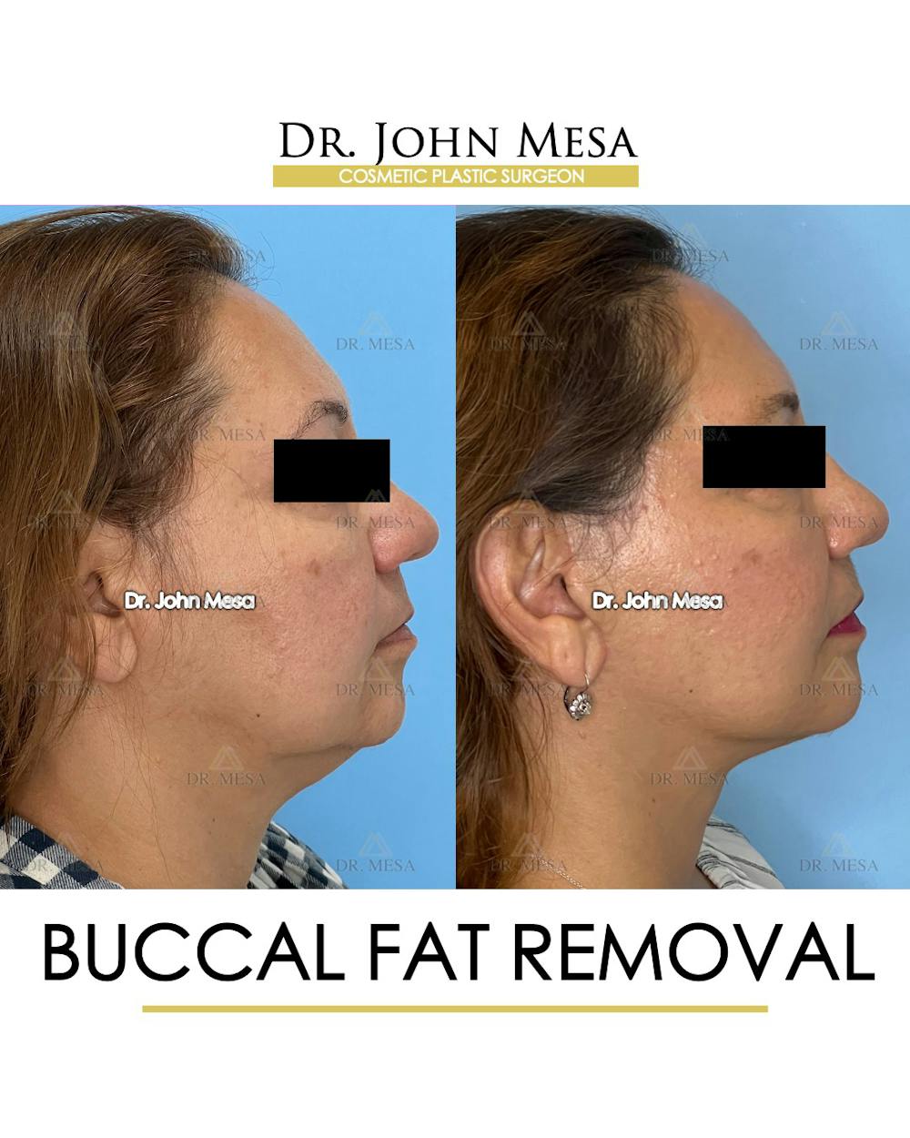 Buccal Fat Pad Removal Before & After Gallery - Patient 148733474 - Image 3