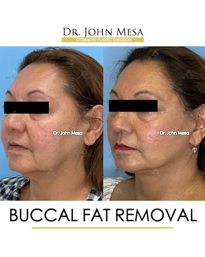 Buccal Fat Pad Removal Before & After Gallery - Patient 148733474 - Image 4