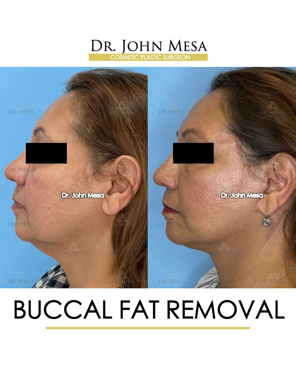 Buccal Fat Pad Removal Before & After Gallery - Patient 148733474 - Image 5