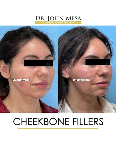 Cheekbone Filler Before & After Gallery - Patient 148735040 - Image 2