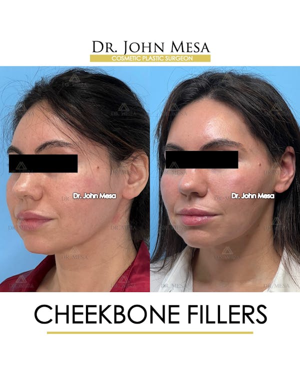 Cheekbone Filler Before & After Gallery - Patient 148735040 - Image 3