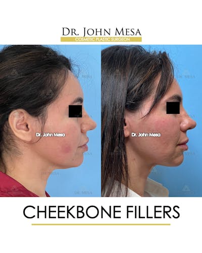 Cheekbone Filler Before & After Gallery - Patient 148735040 - Image 4