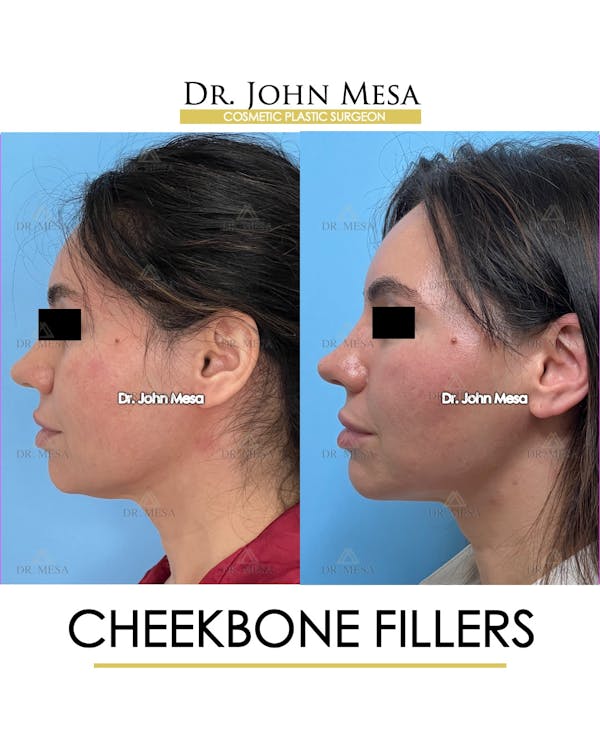 Cheekbone Filler Before & After Gallery - Patient 148735040 - Image 5