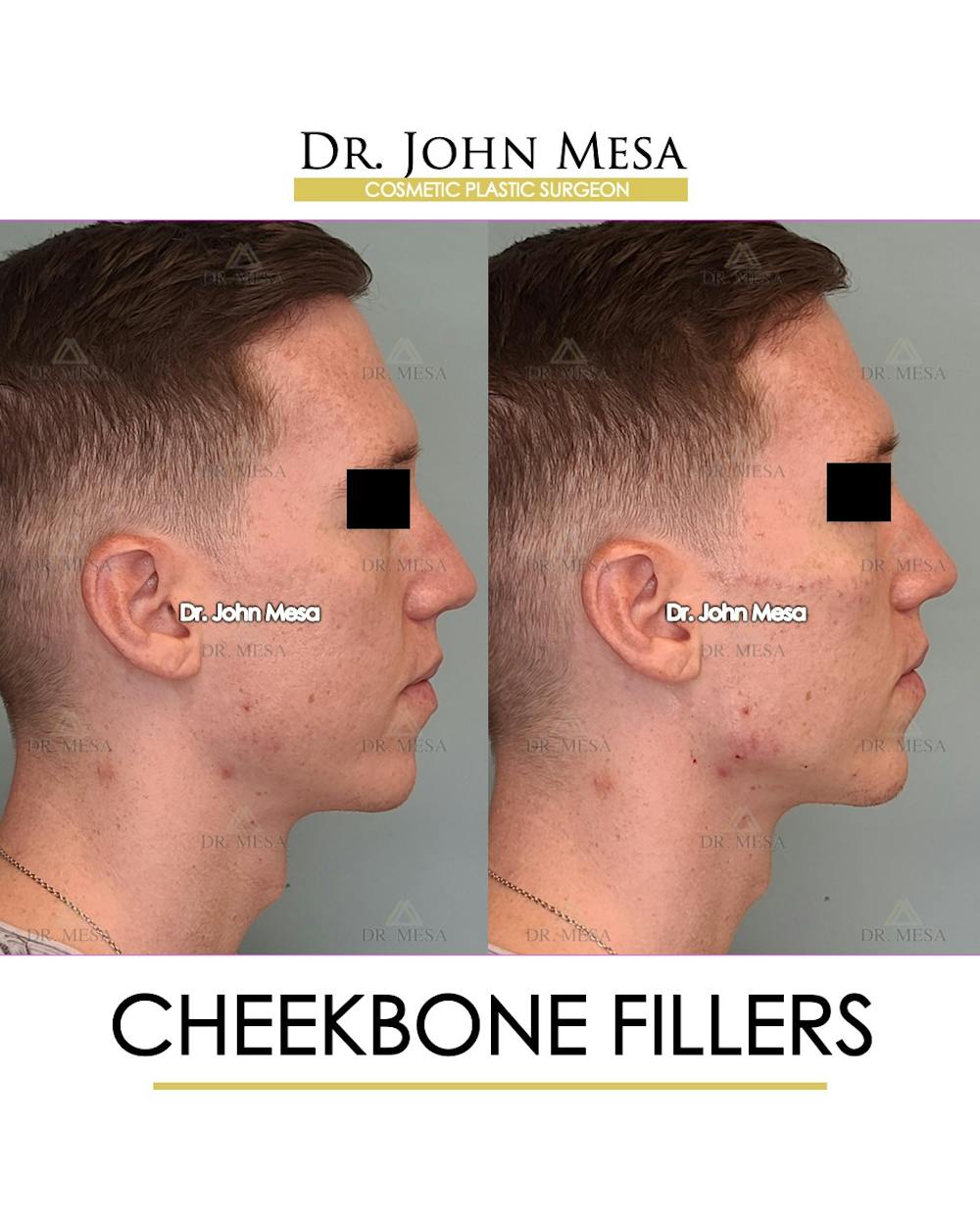 Cheekbone Filler Before & After Gallery - Patient 148735128 - Image 3