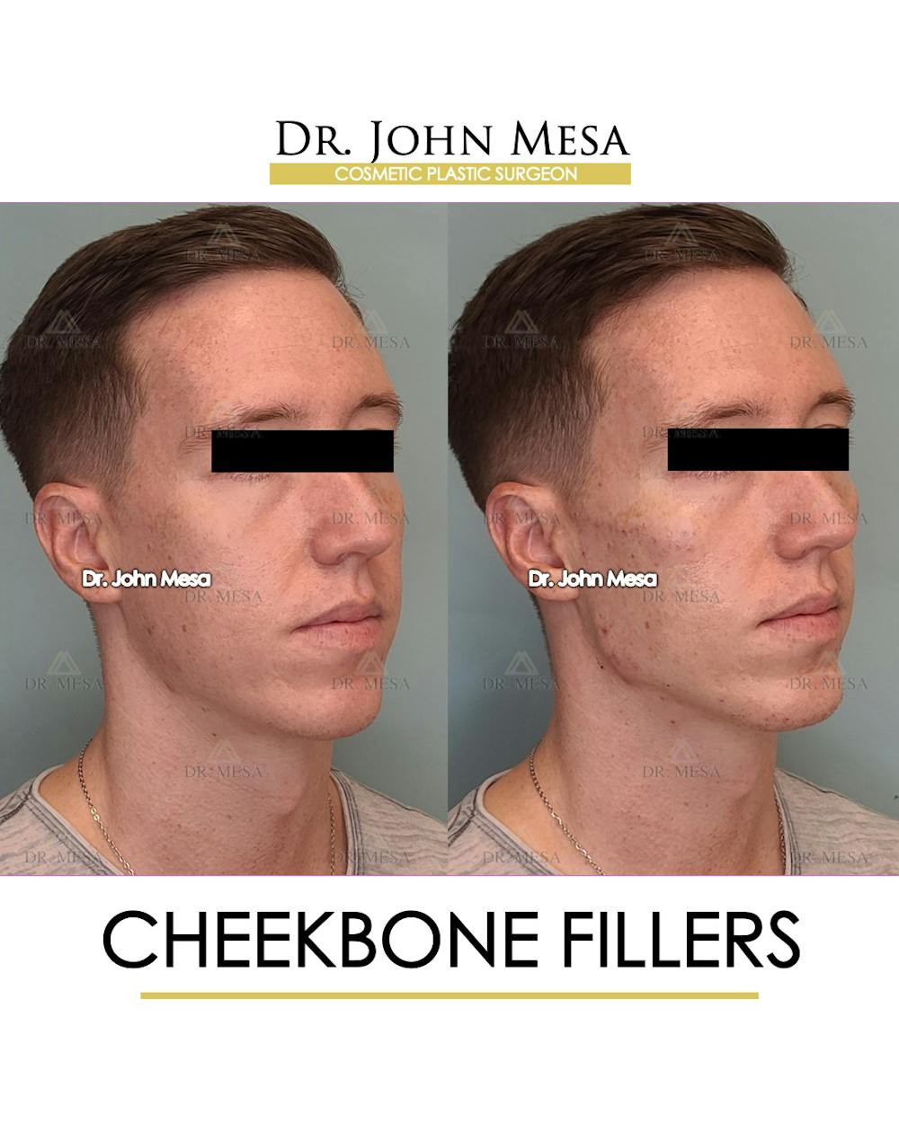 Cheekbone Filler Before & After Gallery - Patient 148735128 - Image 2