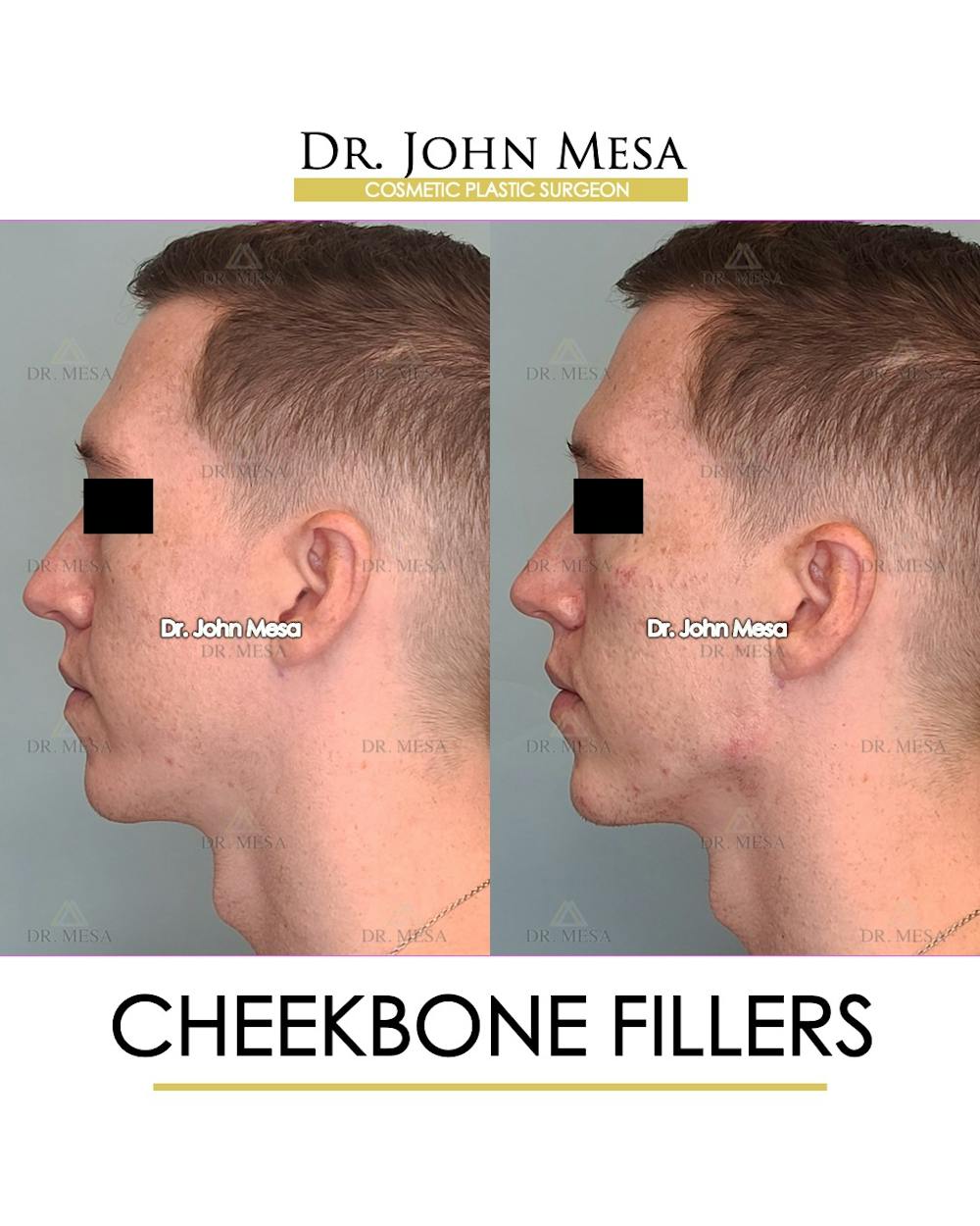 Fillers Before & After Gallery - Patient 148735128 - Image 5