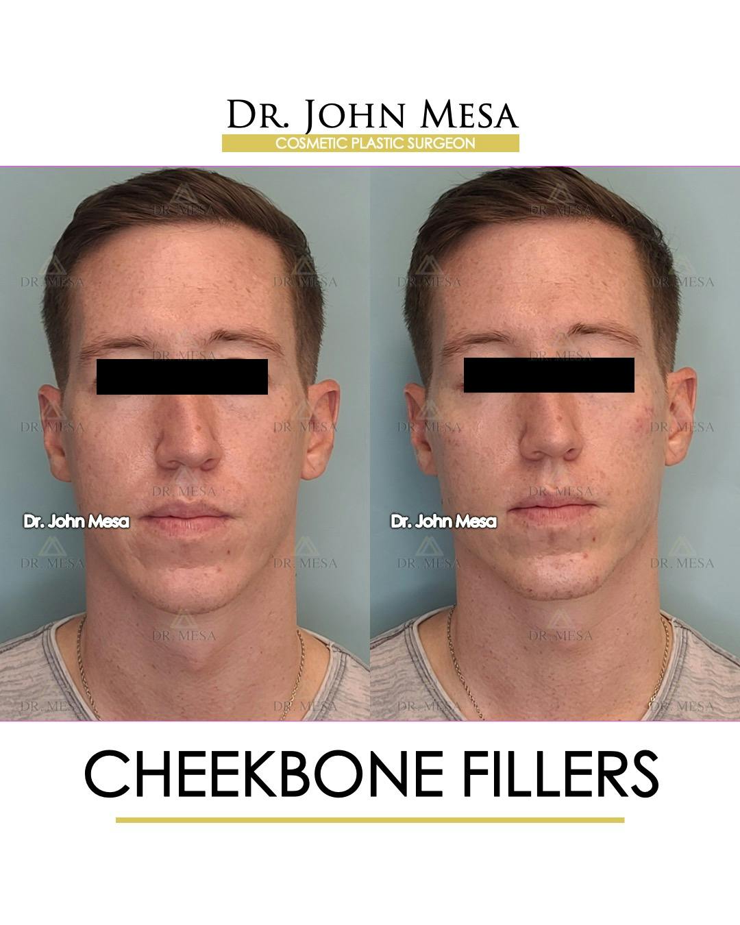 Cheekbone Filler Before & After Gallery - Patient 148735128 - Image 1