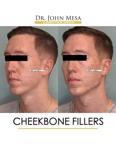 Cheekbone Filler Before & After Gallery - Patient 148735128 - Image 4