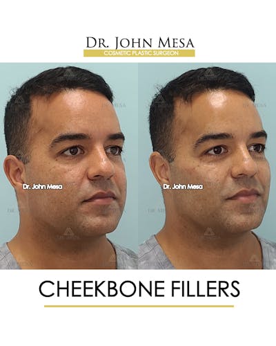 Cheekbone Filler Before & After Gallery - Patient 148735127 - Image 2