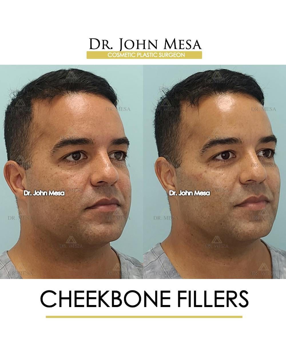 Fillers Before & After Gallery - Patient 148735127 - Image 2