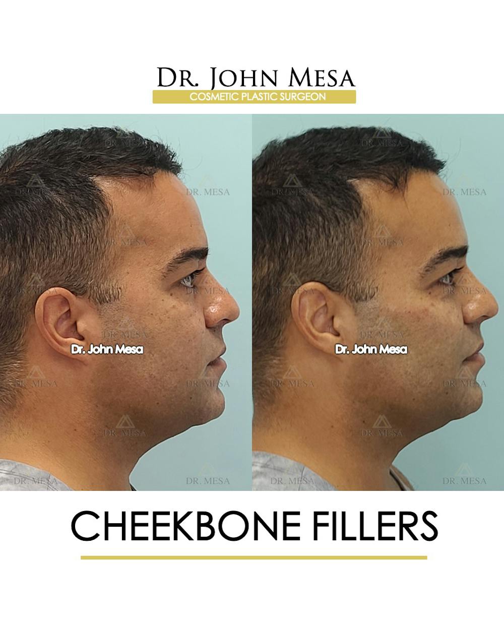 Fillers Before & After Gallery - Patient 148735127 - Image 3