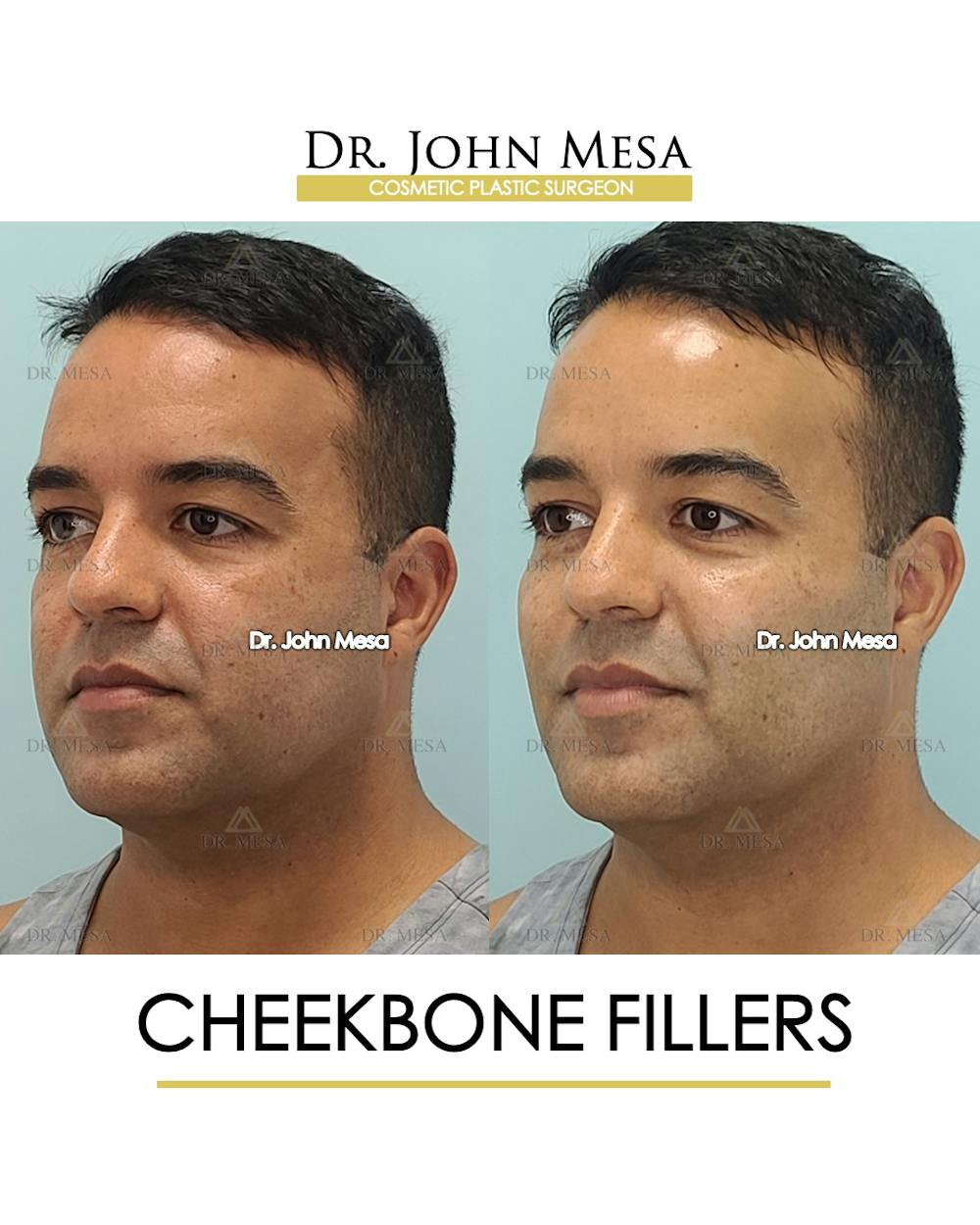 Cheekbone Filler Before & After Gallery - Patient 148735127 - Image 4
