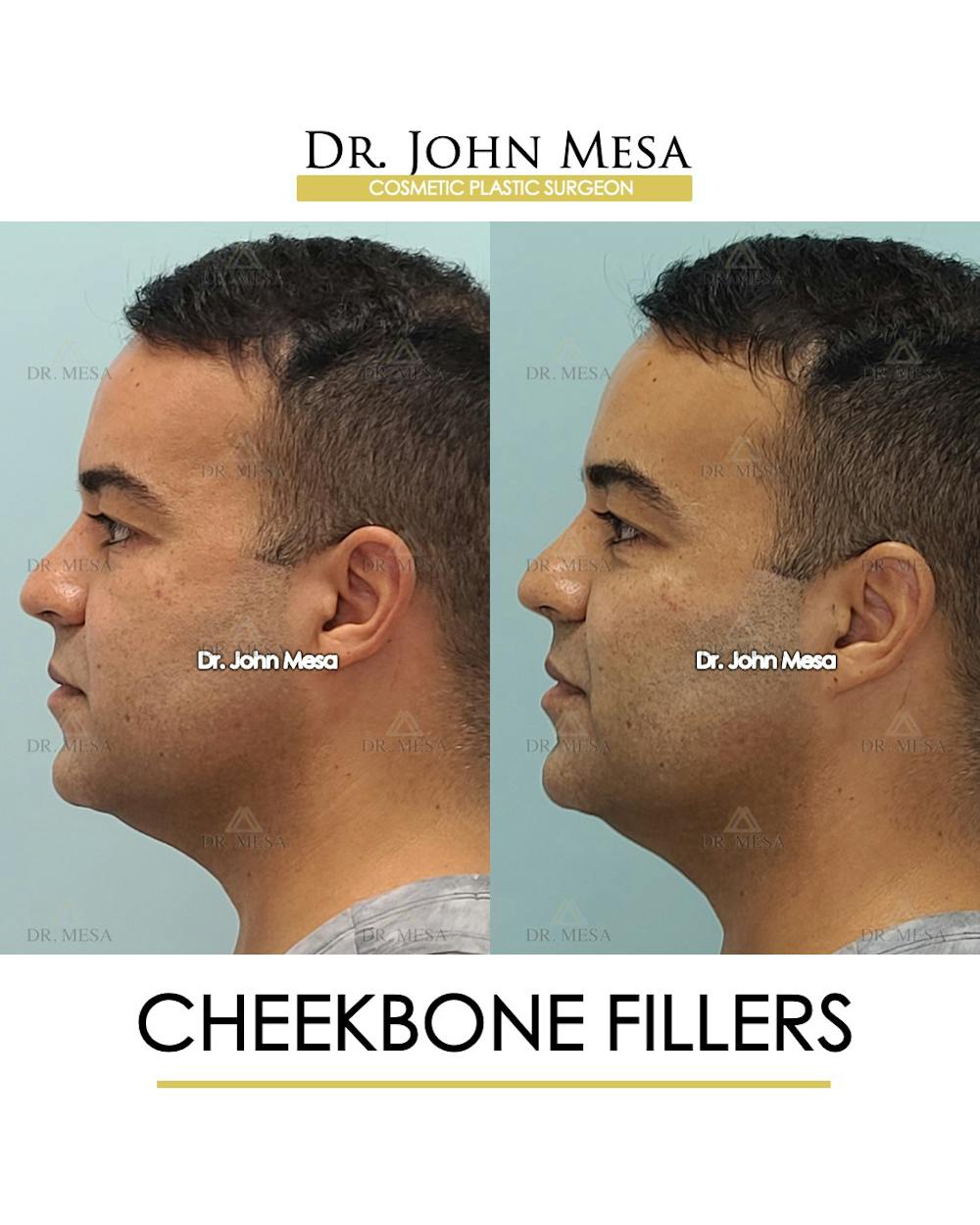 Fillers Before & After Gallery - Patient 148735127 - Image 5