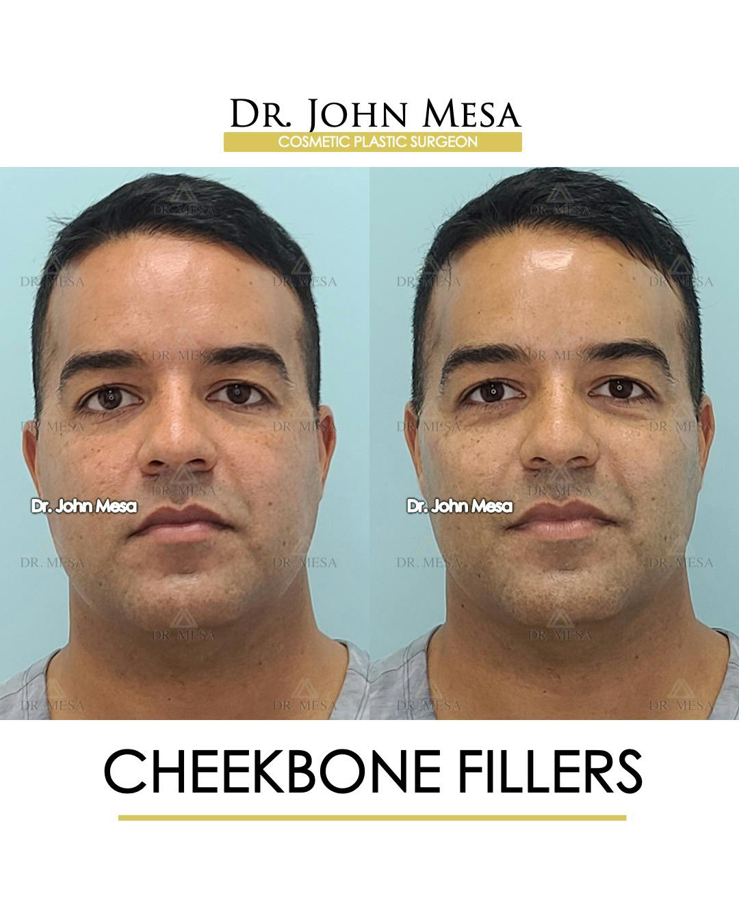 Cheekbone Filler Before & After Gallery - Patient 148735127 - Image 1