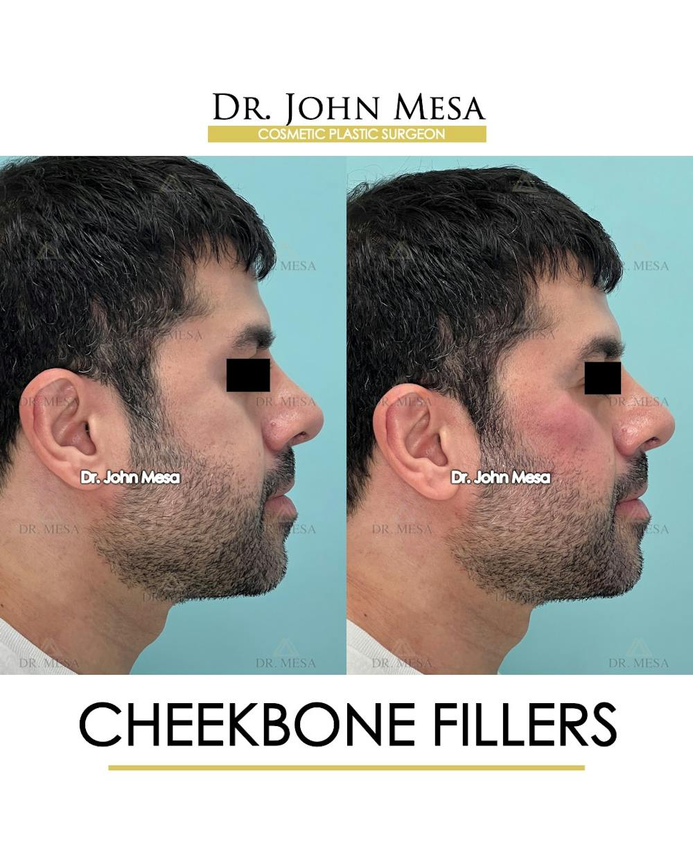 Fillers Before & After Gallery - Patient 148735126 - Image 3