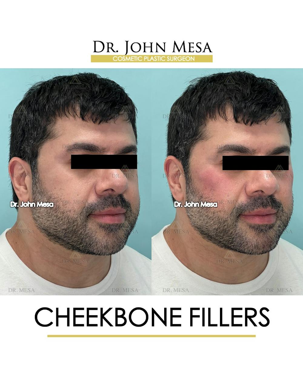 Cheekbone Filler Before & After Gallery - Patient 148735126 - Image 2