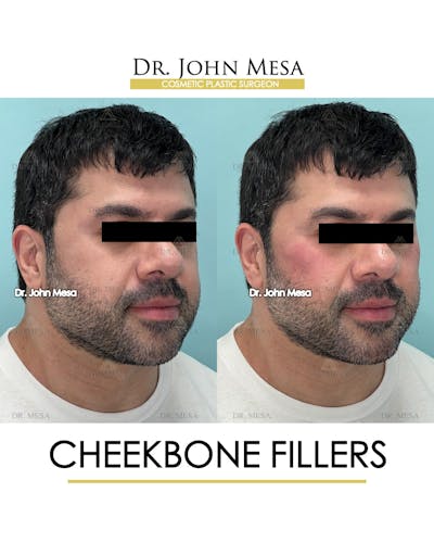 Cheekbone Filler Before & After Gallery - Patient 148735126 - Image 2