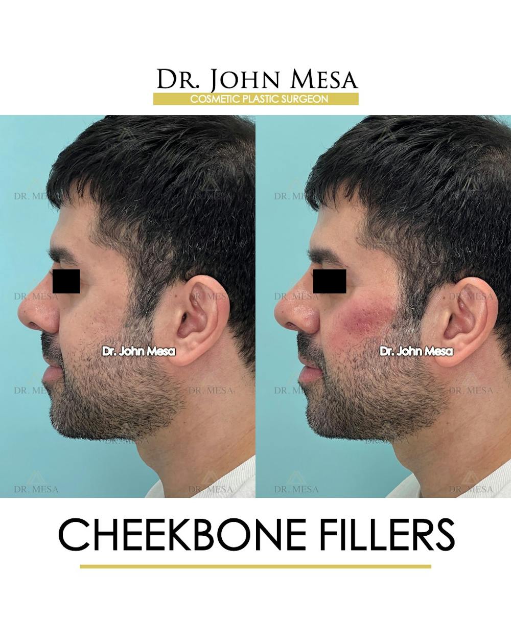 Fillers Before & After Gallery - Patient 148735126 - Image 5