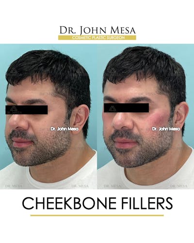 Cheekbone Filler Before & After Gallery - Patient 148735126 - Image 4