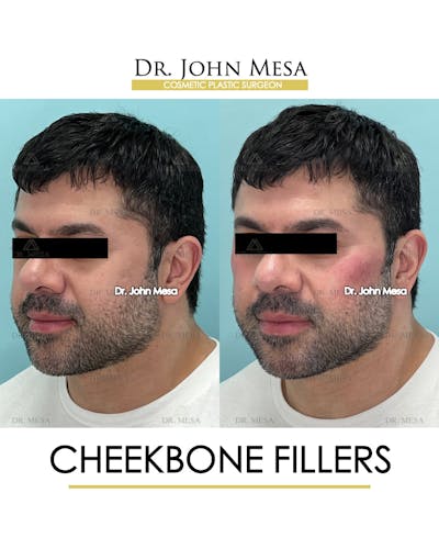 Cheekbone Filler Before & After Gallery - Patient 148735126 - Image 4